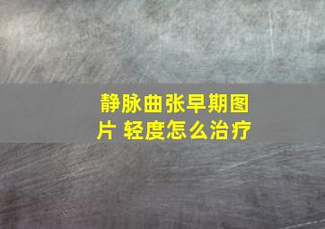 静脉曲张早期图片 轻度怎么治疗